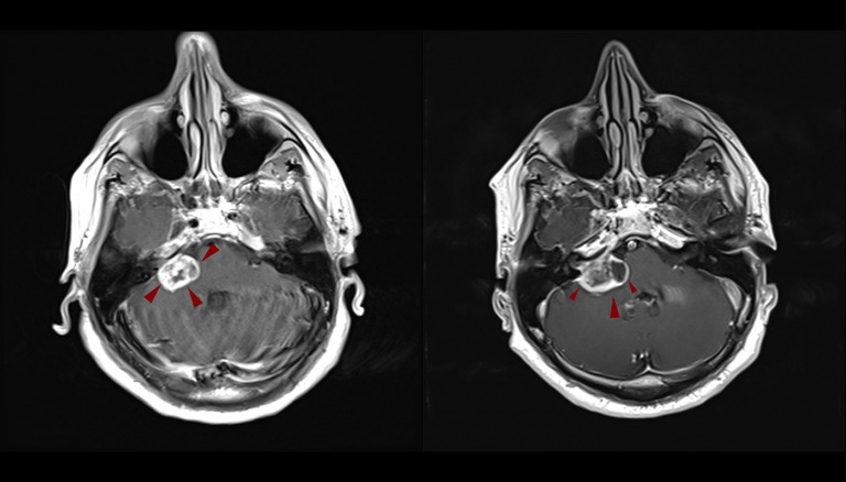 akoustiko neurinoma CYBERKNIFE 768x438 1