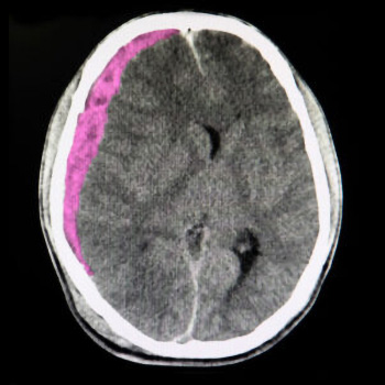 ypoapiskliridio aimatoma