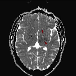 ischemiko aee ΒRAIN MRI 300x300