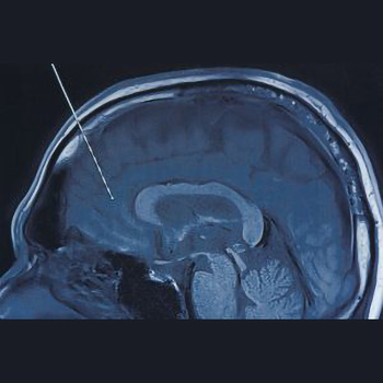 epilypsia antimetopisi 300x200 1