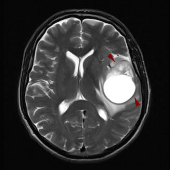 anaplastiko olgodendrodlioma