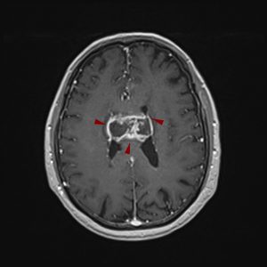 glioma butterfly 300x300 1