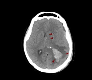 endoegkefaliko aimatoma 300x259