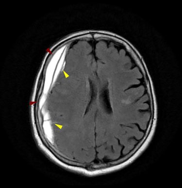 episkliridio yposkleridio aimatoma 375x388