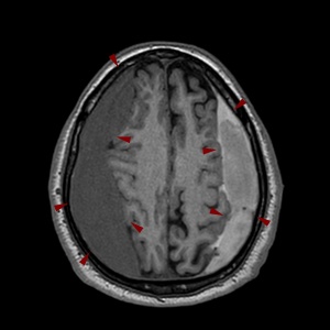 yposkliridio aimatoma 300x300 1