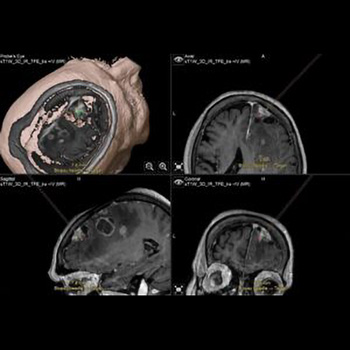 neuroplohghsh