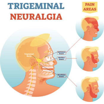 neyralgia tridimou 350x350 1