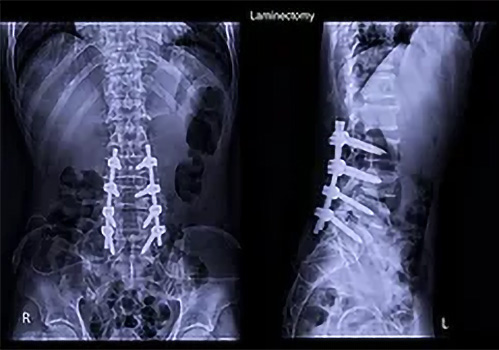 petalectomy