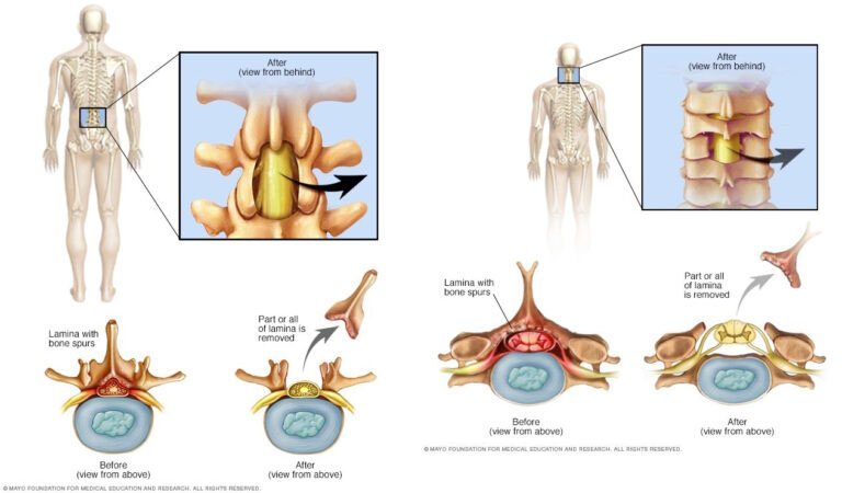 Laminectomy Surgery Cost in India 768x450 1 1