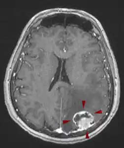 egkefaliki metastasi melanoma 252x300