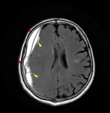 episkliridio yposkleridio aimatoma 375x388
